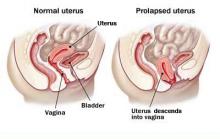 normal uterus and prolapsed uterus